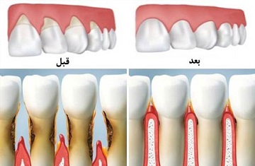 پیوند لثه توسط دکتر زهرا ظهری در رشت